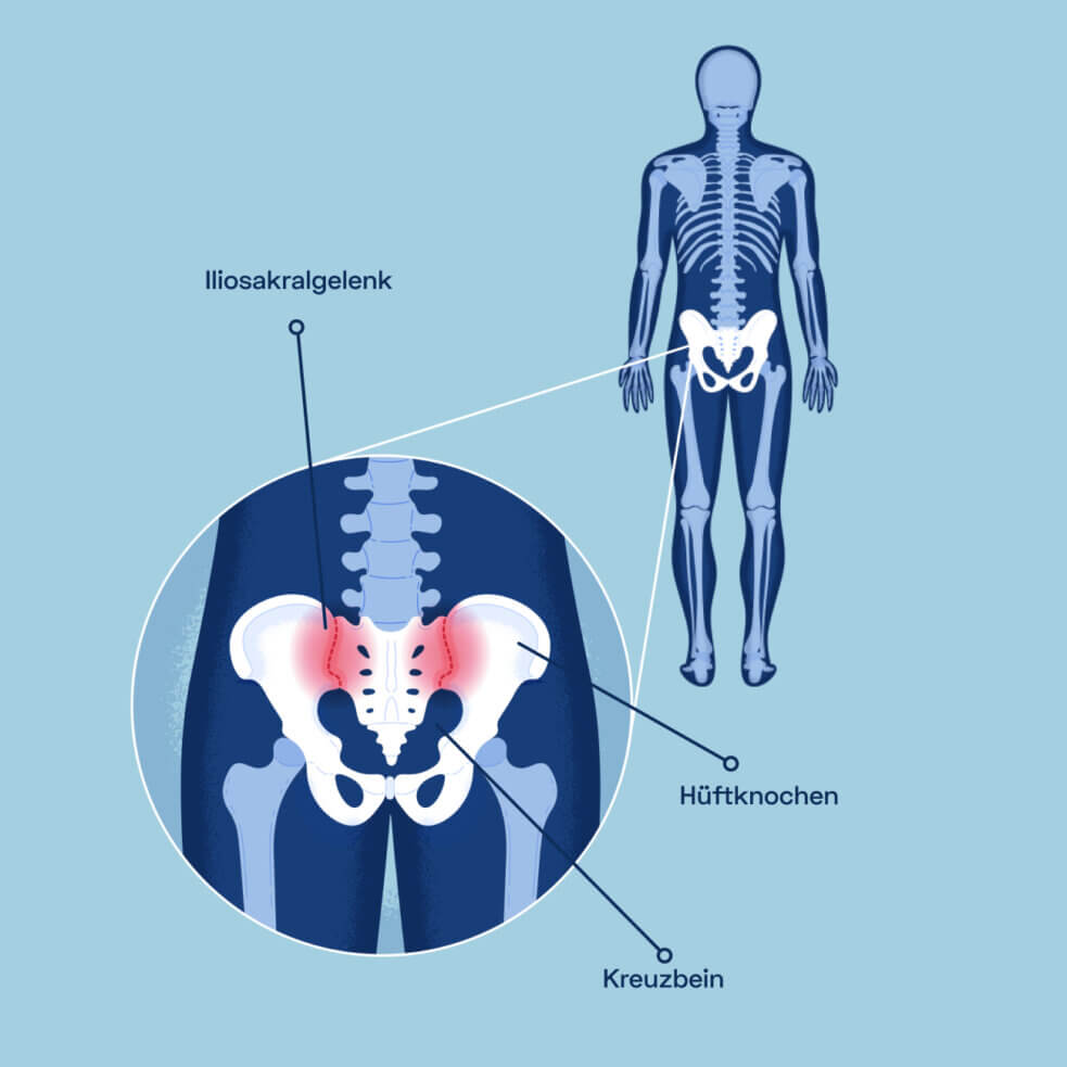 Rückenschmerzen: Ursachen, Behandlung und Symptome | Kaia