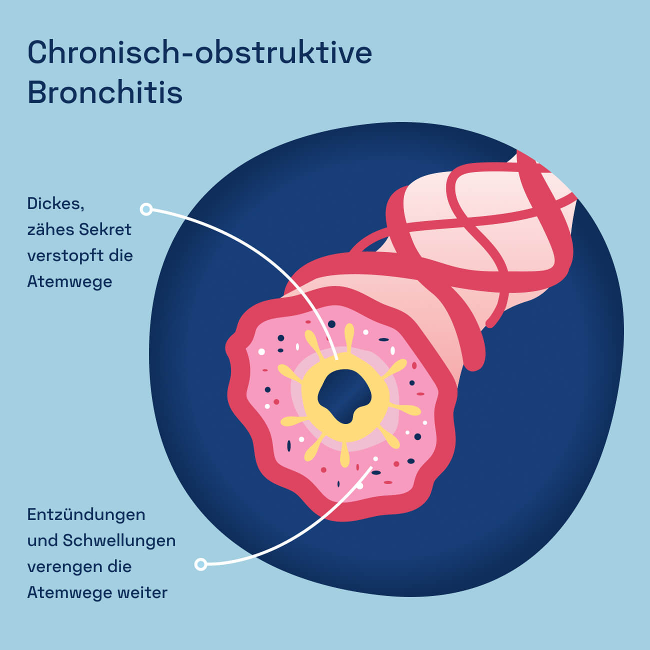 Abbildung Bronchien