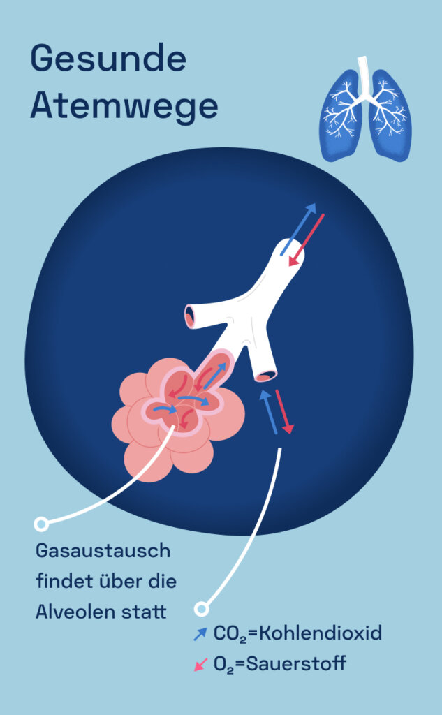 COPD Ursachen, Behandlung und Symptome Kaia Health